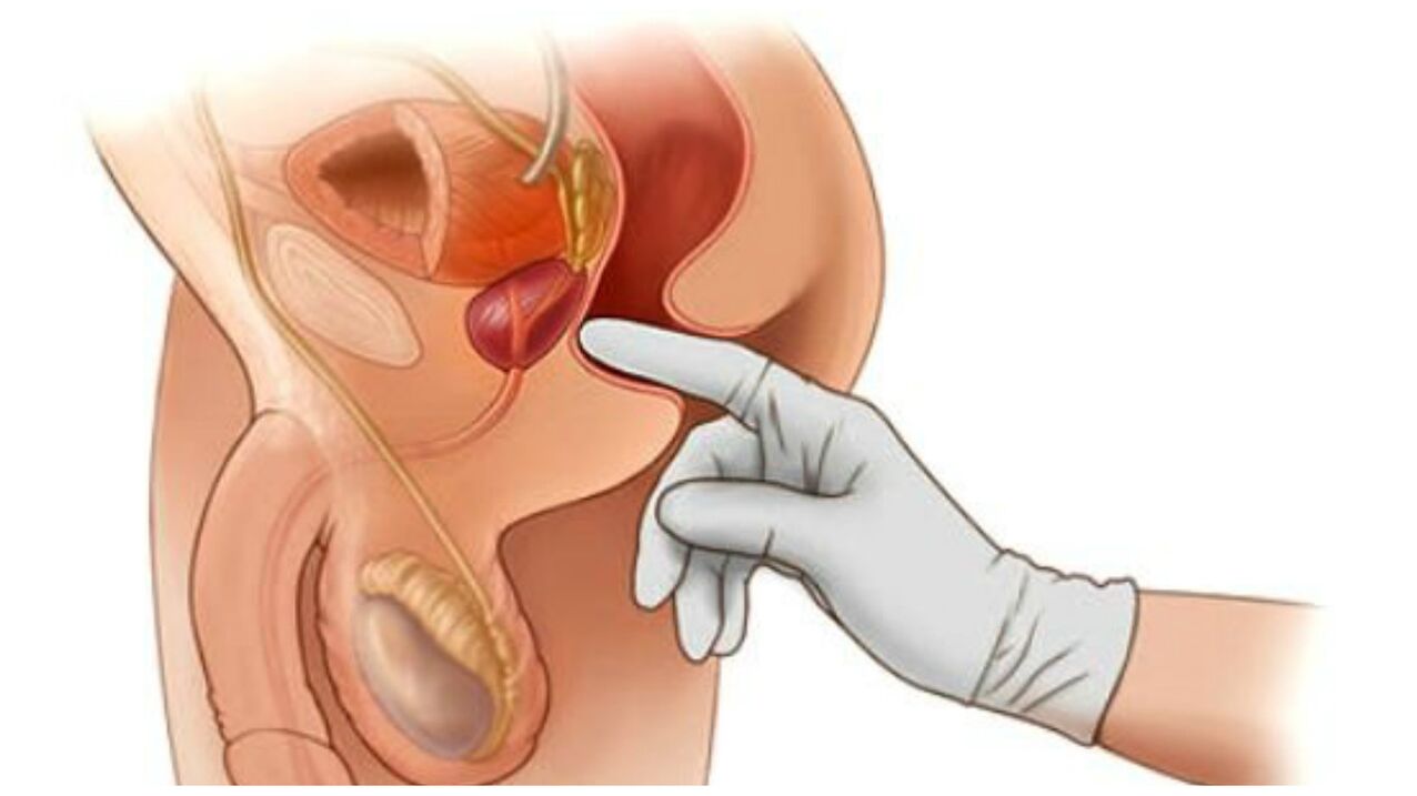 prostatako masajea prostatitis kronikorako