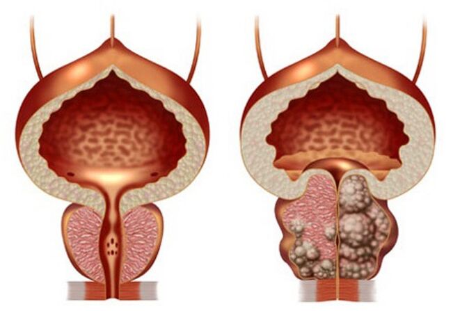 prostatako osasuntsua eta prostatako adenoma