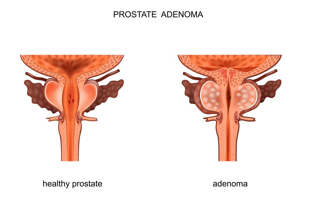 prostata osasuntsua eta adenomarekin